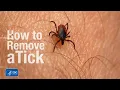 How to remove a tick