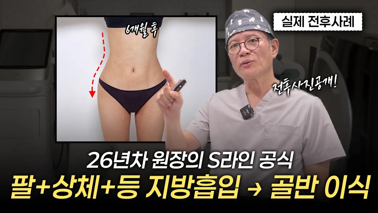 26년차 원장의 S라인 공식! 팔+상체+등지방흡입+골반지방이식