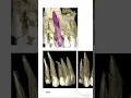 LONGEST TOOTH TREATED EVER 40 79 millimeters