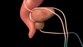 Surgery for Prostate Cancer: Robotic Radical Prostatectomy