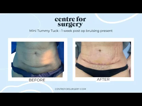 Abdominoplasty How To Heal Infected Belly Button Mini Tummy Tuck - Main Image