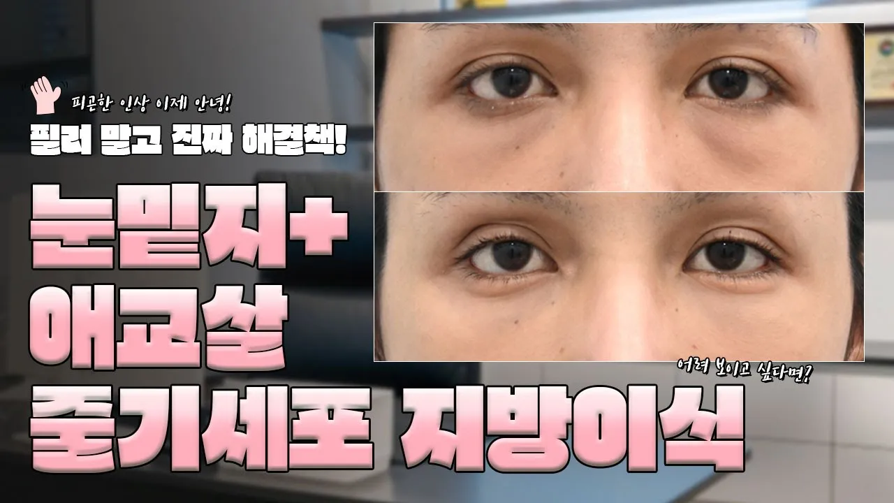 필러 말고 진짜 해결책! 눈밑지방재배치+ 애교살 줄기세포 지방이식