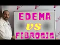 Edema VS Fibrosis - What s the Difference Liposuction Contour Irregularity Lipo Lumps and Bumps