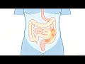 New ASGE Guideline Endoscopic Management of Colonic Strictures