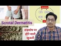 Causes of itching on the testicles - Part 1 Scrotal Dermatitis Scrotal Eczema