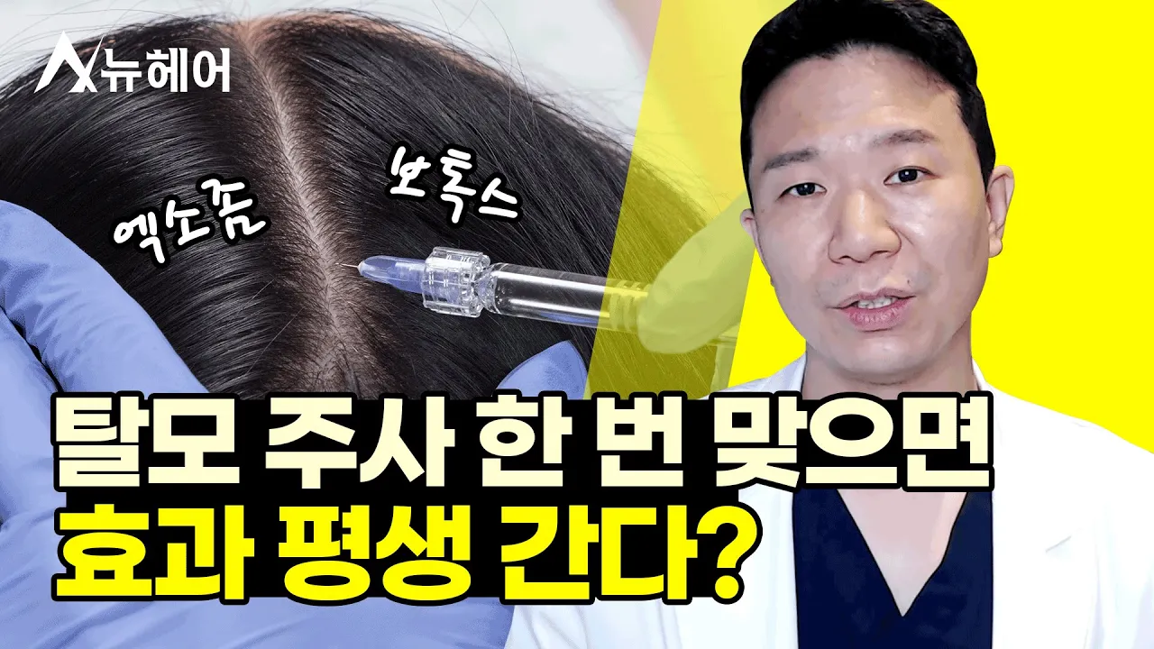 엑소좀 보톡스 탈모 주사 치료는 효과가 영구적일까?