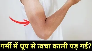 धूप से काली त्वचा — Sunburn का 5 घरेलू इलाज, Tanning तुरंत हटाएं | Skin Care Hindi