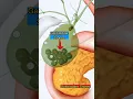 Download Lagu Gallbladder Stones 3D Animation |Medical| #3d #medical