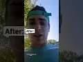 Before and After 50mg of Vyvanse