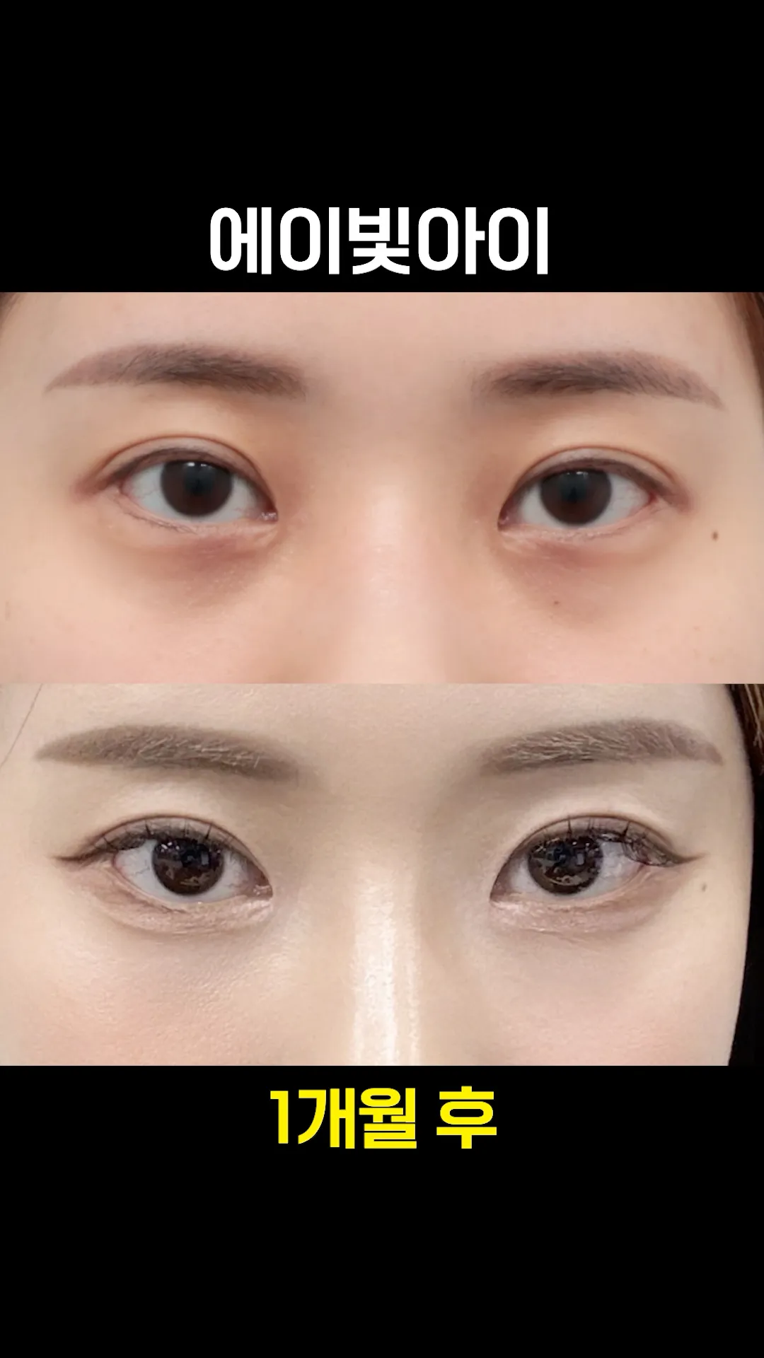 컨실러 보다 나은 다크서클 주사