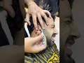 Removing ingrown hair from the ear