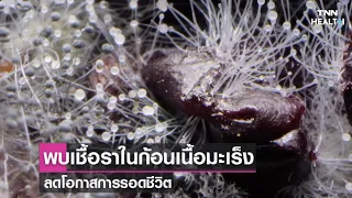 เชื้อราที่พบในผู้ป่วยมะเร็งมีผลต่อการรักษาหรือไม่