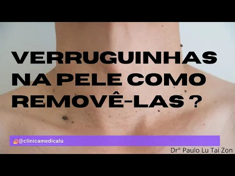 Download MP3 O que são e como tratar as verruguinhas de pele do seu pescoço , axila ou face ? #verruguinha