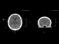 Unremarkible Non Contrast CT Coronal Scan Example 3