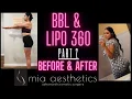 I GOT A BBL PART 2 MIA AESTHETICS AUSTIN TX DR CHAREPOO BEFORE AND AFTER
