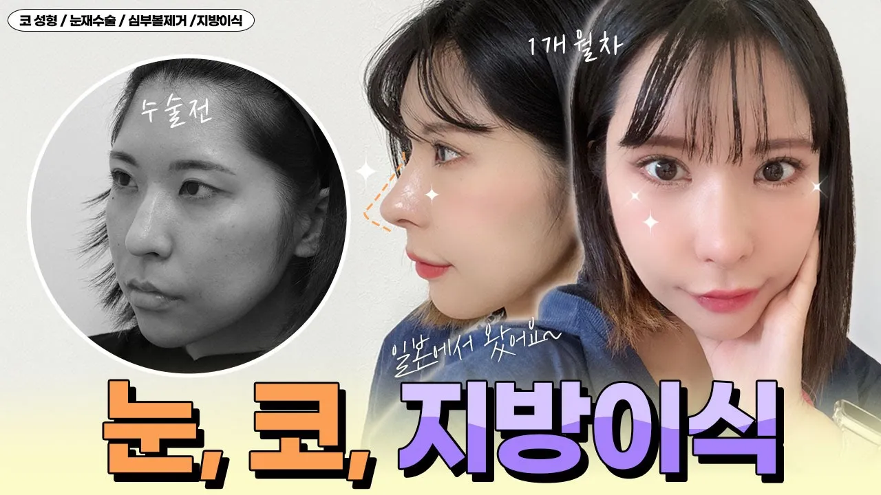 [VLOG] 눈재수술, 첫코, 지방이식💜 일본에서 왔어요~