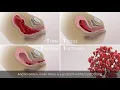 Management of Postpartum Hemorrhage (PPH) | Etiologies, prevention, treatment | TVASurg