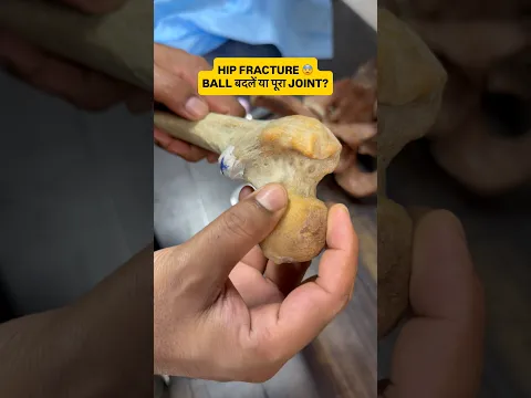Femur fracture में नया जोड़ कैसे तैयार होता है?? #femur #femurfracture #bonehealth