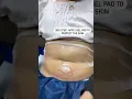 Cool Sculpting for the Tummy in Action