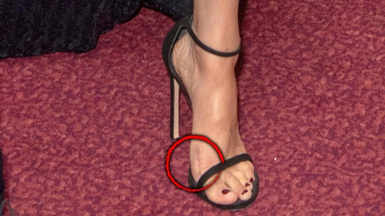 What’s That Scar on Meghan Markle’s Foot?