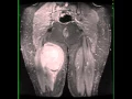 Synovial Sarcoma Thigh