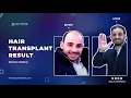 Download Lagu نتيجة زراعة الشعر بعد سنة , .زراعة 6000 بصيلة , Hair Tansplant in Turkey , Dr Ali Yuva