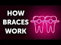 How Braces Work And Why So Slow
