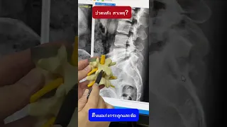สาเหตุหลักที่ทำให้เกิดอาการปวดหลังร้าวลงสะโพกในผู้ป่วยรายนี้คืออะไร