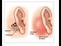 Mastoidectomy CPT code - simplify medical coding