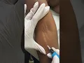 Stretch Marks Inkless Removal Boleyn Treatment Los Angeles