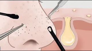 [속 시원한 ASMR] 다양한 도구들을 사용한 코 피지, 블랙헤드 압출 애니메이션! 루루팡
