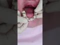 Download Lagu Dental implant’s All on 4 #shorts #smile  #impossible  #dentist #best #new #beautiful #shortvideo