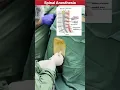 Download Lagu How spinal Anesthesia procedure is performed in Surgery #doctor #mbbs #neet #medical #anesthesia