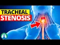 Tracheal Stenosis Medical Definition Quick Explainer