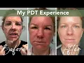 Photodynamic Therapy PDT Skin Cancer Prevention Actinic Keratosis Treatment
