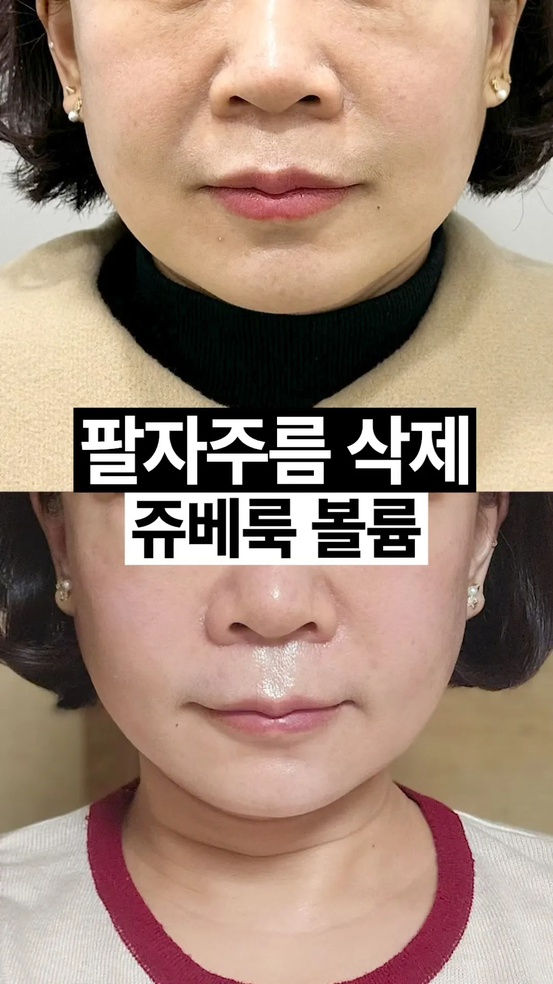 팔자주름 간단하게 없애는 법👀