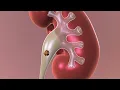 Observation Non-surgical Approach to Kidney Stones