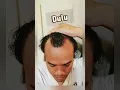 Download Lagu hampir botak di usia 20an #shorts #feedshorts #shortsfeed #shortvideo #hairfall
