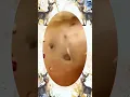 Blackheads Removal Acne Treatment and Very Satisfying Satisfying Pimple pop
