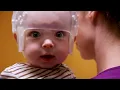 Download Lagu Craniosynostosis | Fitz’s Story