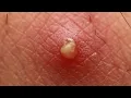 REMOVE A BOIL PERMANENT RESULTS RIGHT NOW