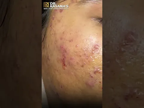 Blackheads Removal - Dr Lalit kasana #blackheads #blackheadsremoval