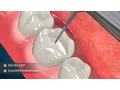 Dental Inlay - Tooth Restoration Procedure