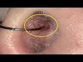 how to get rid of piercing bump inside my nose fast