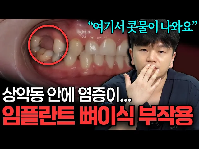 [부산치과] 상악동 거상술은 제발 잘하는 곳 가세요. 임플란트 뼈이식 부작용 솔직히 말씀드립니다.