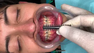 🔥Cambio de Módulos Elásticos🔥