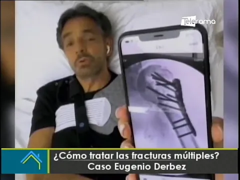 ¿Cómo tratar las fracturas múltiples? caso Eugenio Derbez