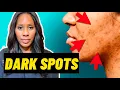 FADE DARK SPOTS FAST Doctor Reveals the BEST OTC Treatments for Post-Inflammatory Hyperpigmentation