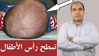 تسطح رأس الاطفال الاسباب والعلاج Flat Head Syndrome 