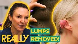 Download Dr. Emma Removes Painful Lipoma and Keloid From The Neck And Ear! | The Bad Skin Clinic MP3
